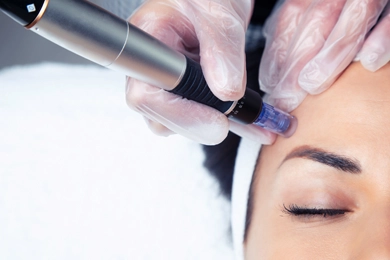 Can Home Microneedling Be Performed?