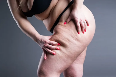 Lipedema Treatment with VASERLipo (Vaser Liposuction)