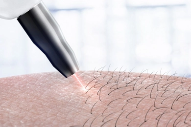 What Factors Affect Laser Hair Removal Prices?