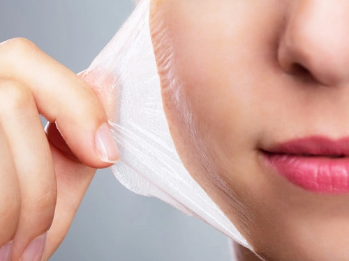 Kimyasal Peeling