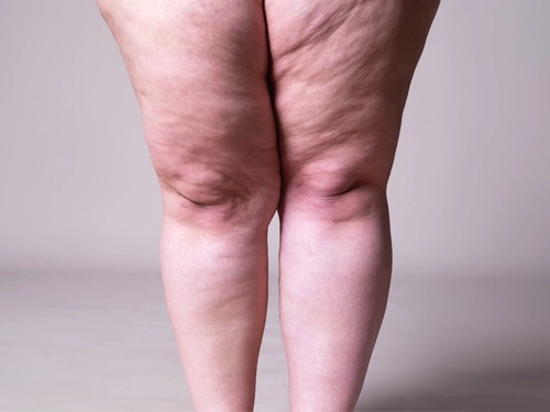 Lipedema Treatment Turkey