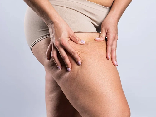 Lipödemde Liposuction Normalden Farklı Mı?