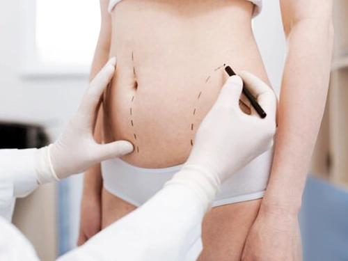 Vaser Abdominoplasty Turkey