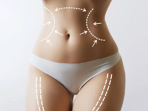 Yağ Aldırma (Liposuction)